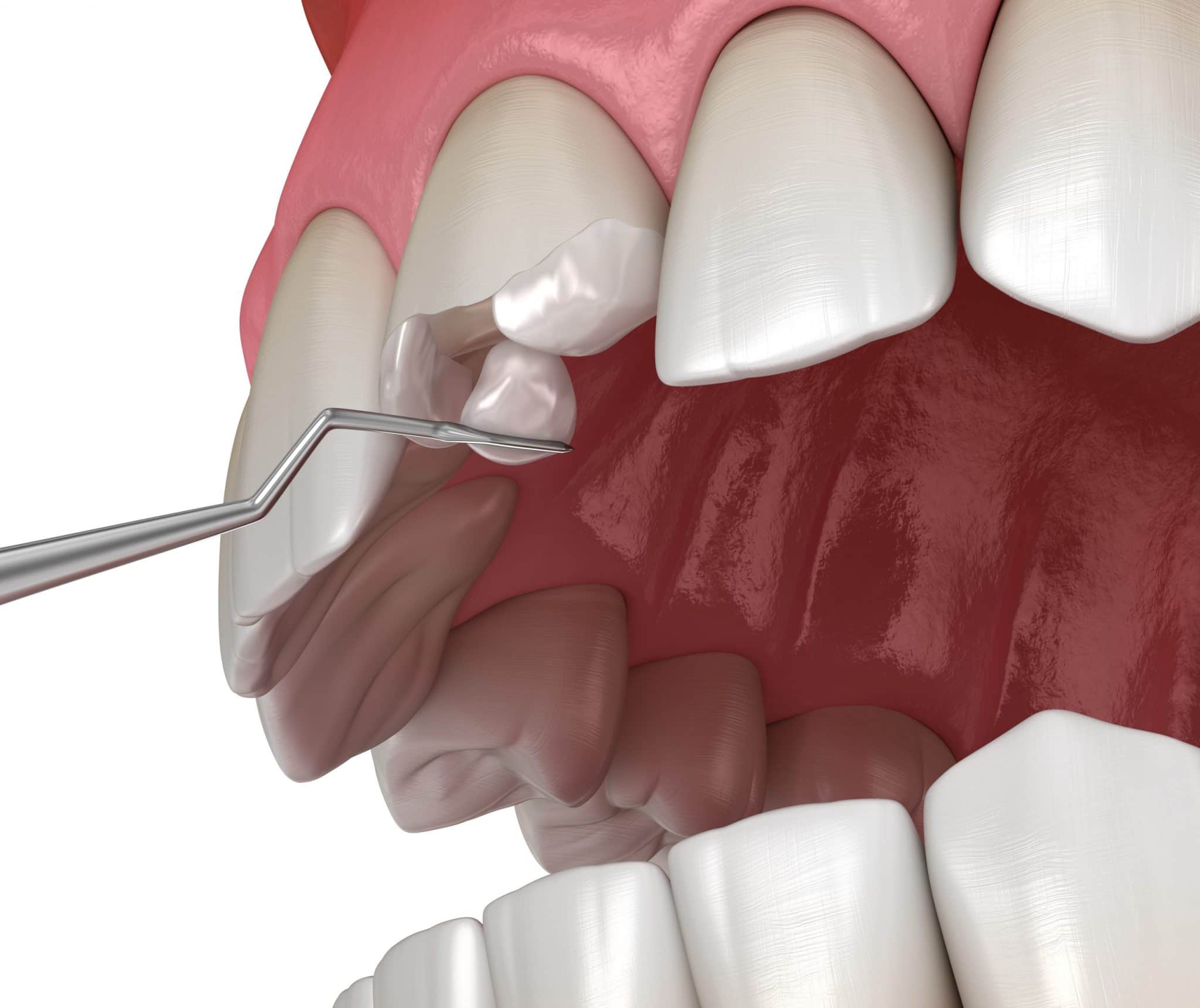 Restorative Dentistry at Al Afdal Medical Center Sharjah
