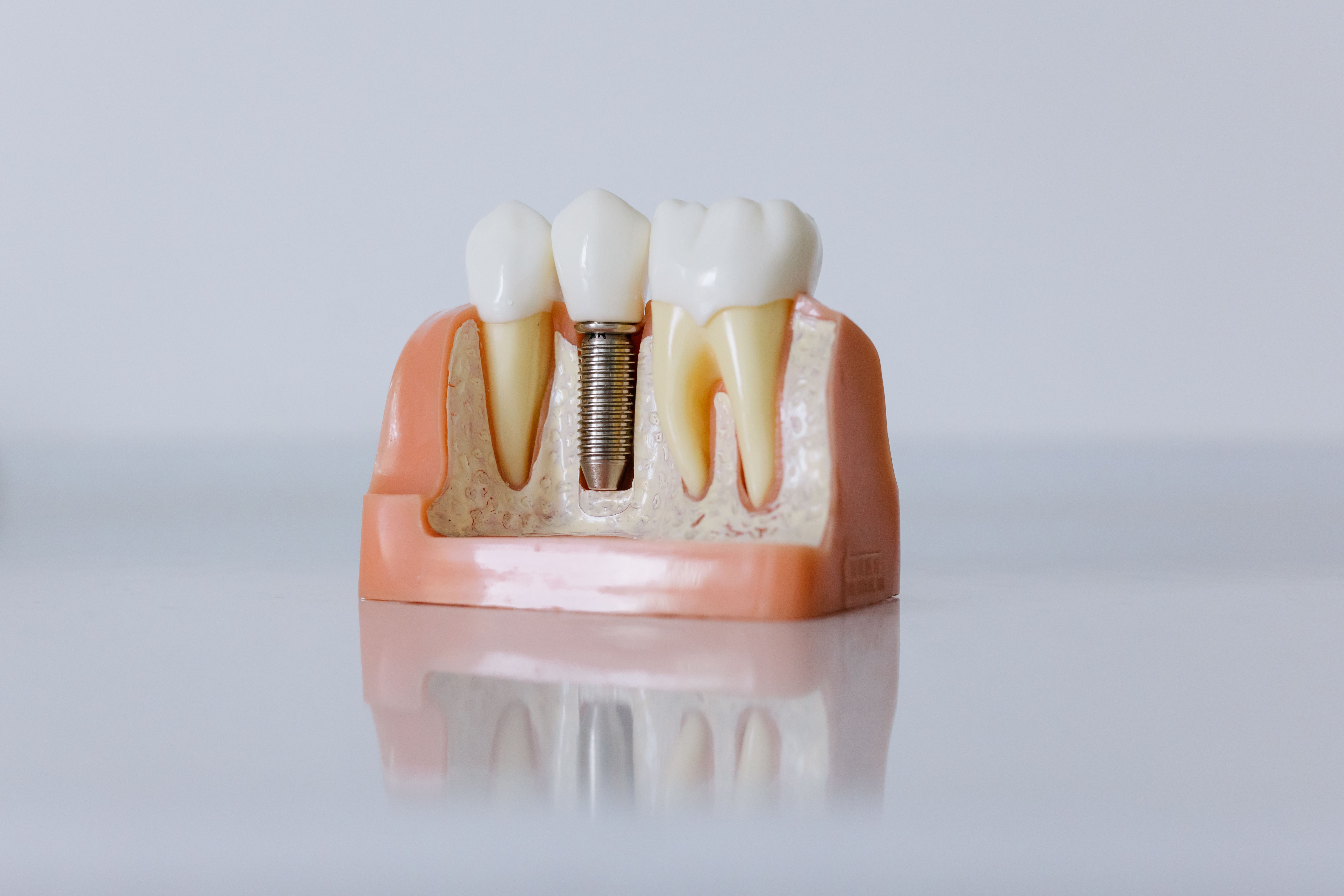 Advanced dental implant procedure at Al Afdal Medical Center