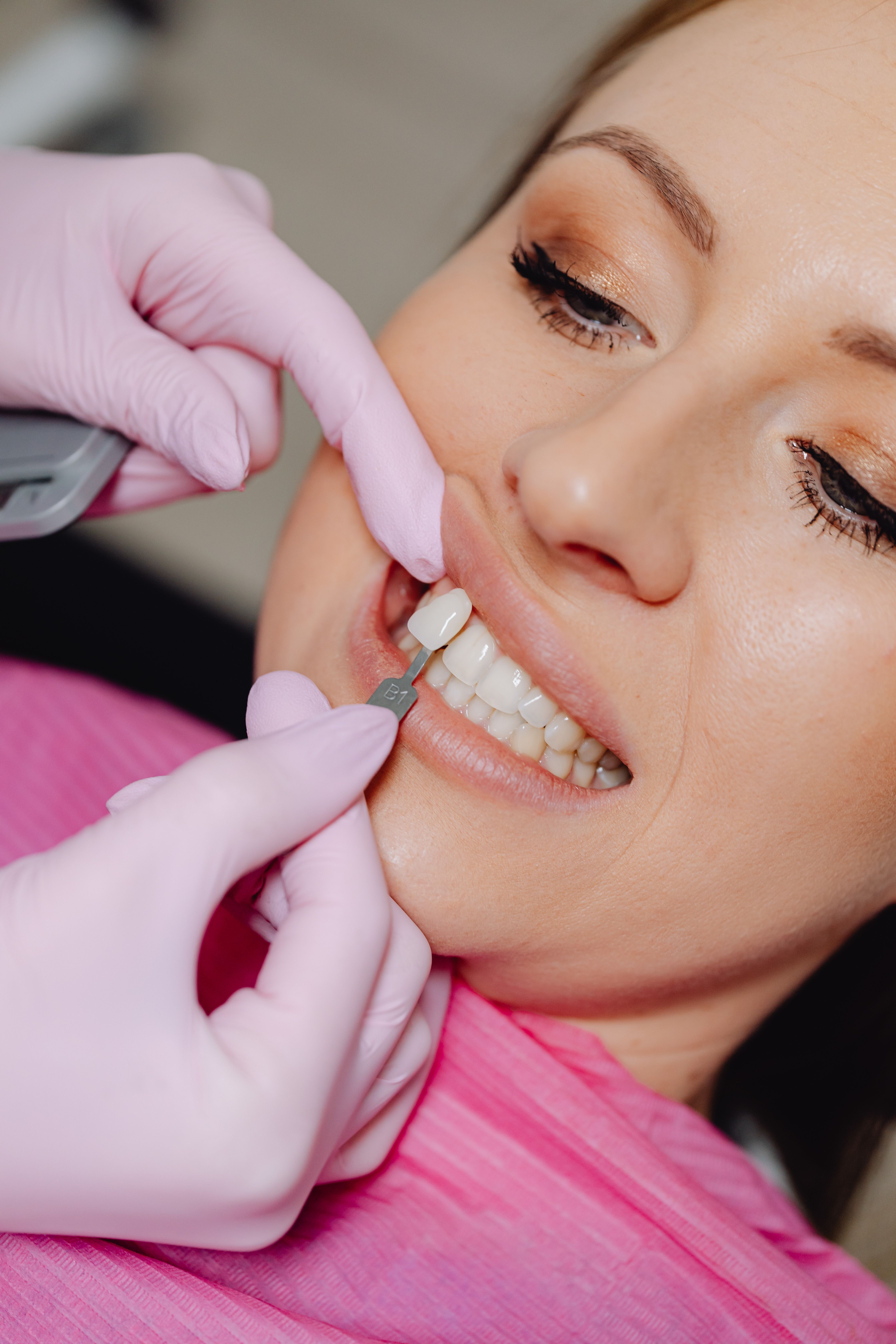 Premium porcelain veneers at Al Afdal Medical Center