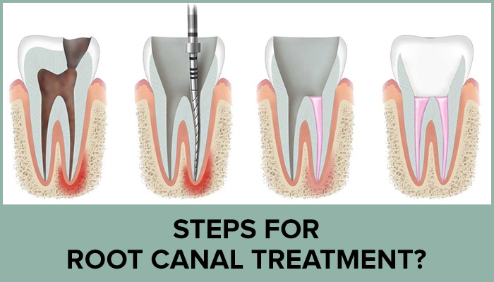  Root canal Treatments